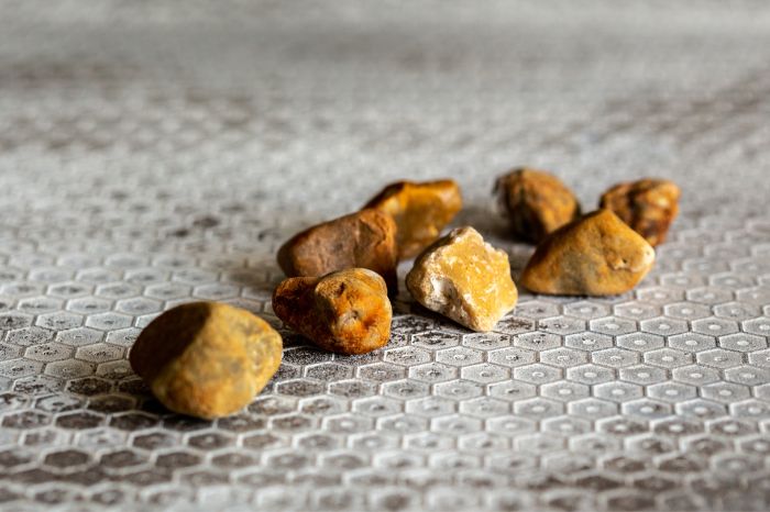 Pedras tiradas retiradas da vesícula.